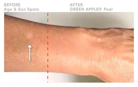 Green Apple Results - Before and After Image - Learn More